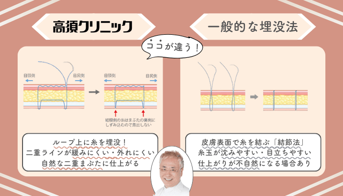 高須クリニック二重埋没法一般的な施術法との違い