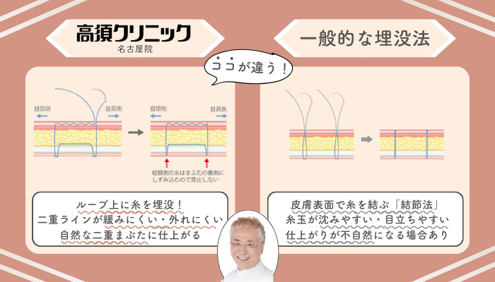 高須クリニック名古屋二重埋没法一般的な施術法との違い