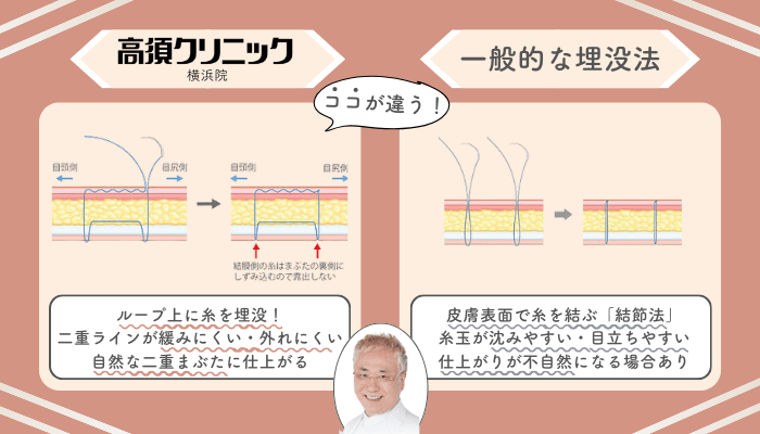 高須クリニック横浜二重埋没法一般的な施術法との違い