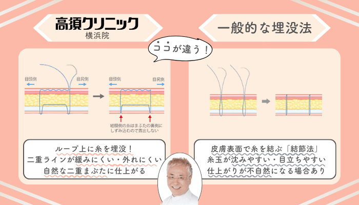 高須クリニック横浜埋没一般的な施術法との違い