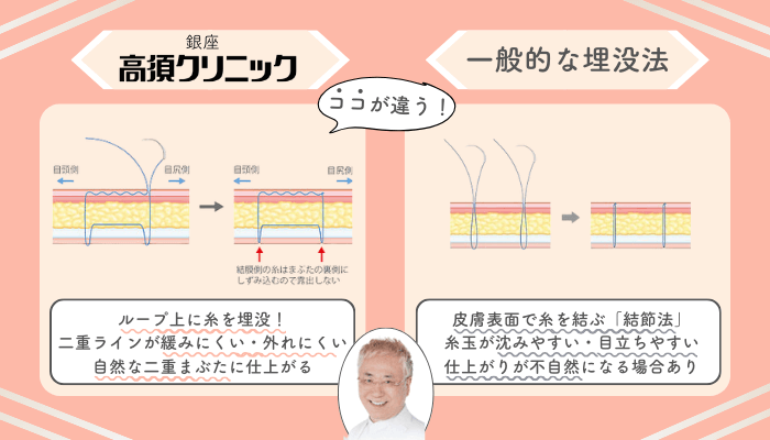 銀座高須クリニック埋没一般的な施術法との違い