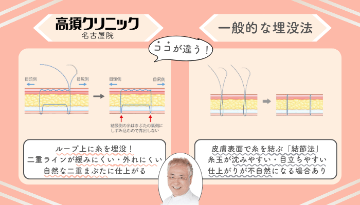 高須クリニック名古屋埋没一般的な施術法との違い