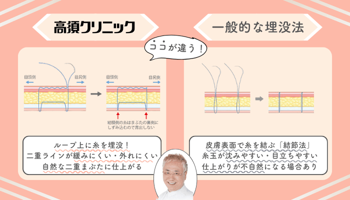 高須クリニック埋没一般的な施術法との違い