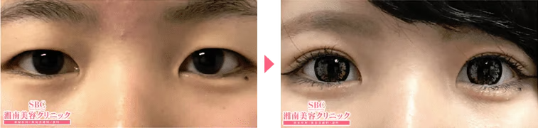 SBC二重整形症例