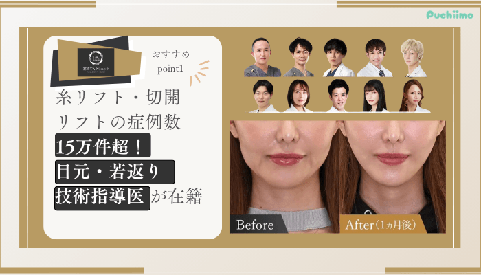 高崎TAクリニック糸リフトおすすめポイント1