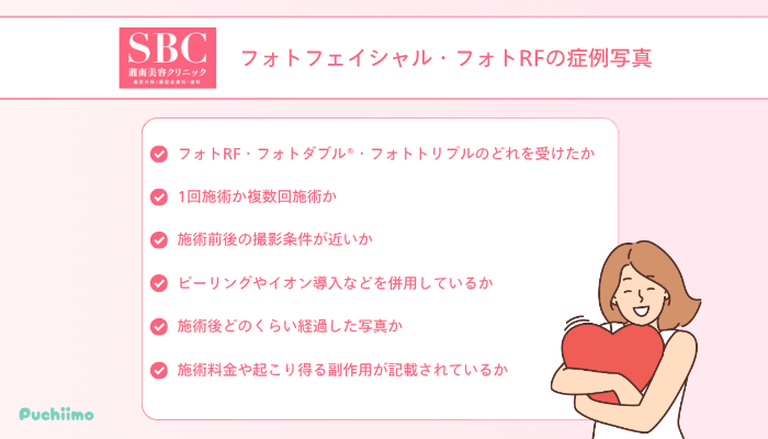 SBCのフォトフェイシャル・フォトRFの症例写真