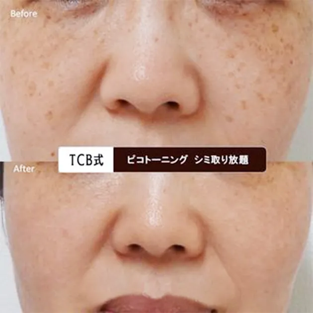 TCBシミ取り放題症例