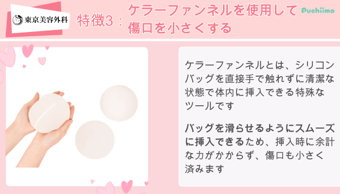 東京美容外科東美式シリコンバッグ豊胸特徴3