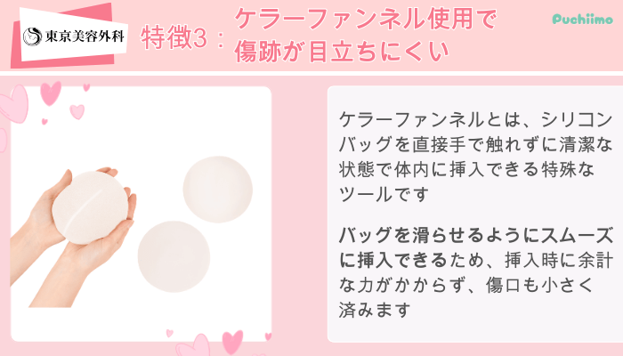 東京美容外科東美式シリコンバッグ豊胸特徴3