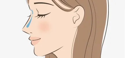 TA鼻のヒアルロン酸注射