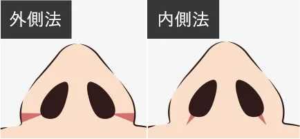 TA鼻翼縮小術