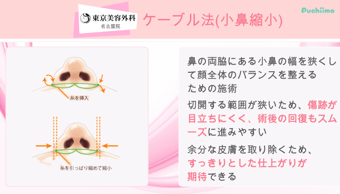 東京美容外科名古屋鼻整形ケーブル法小鼻縮小