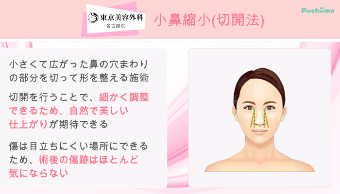 東京美容外科名古屋鼻整形小鼻縮小切開法