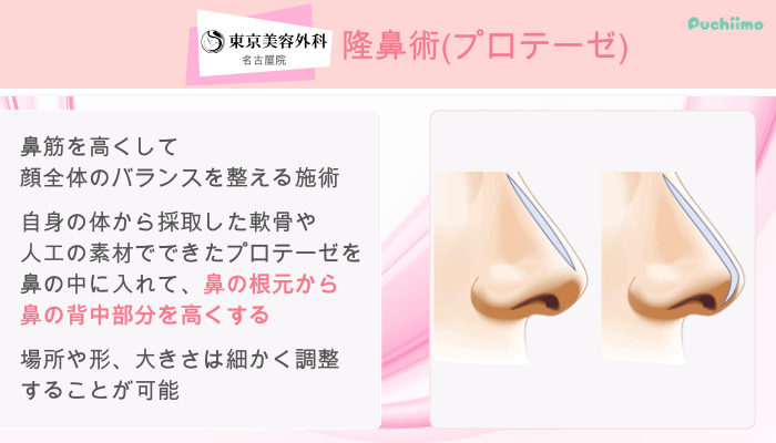 東京美容外科名古屋鼻整形隆鼻術プロテーゼ