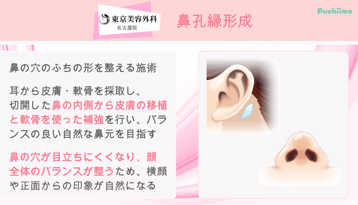 東京美容外科名古屋鼻整形鼻孔縁形成