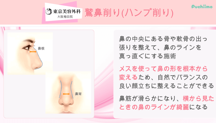 東京美容外科大阪梅田鼻整形鷲鼻削りハンプ削り