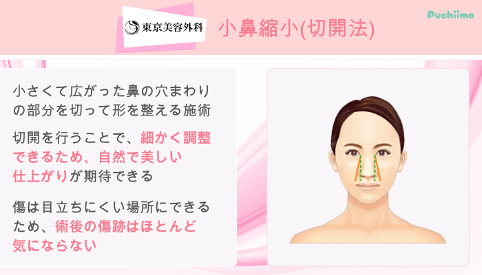 東京美容外科鼻整形小鼻縮小切開法