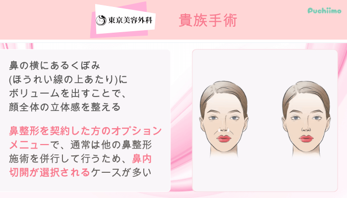 東京美容外科鼻整形貴族手術