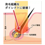 SBCの医療脱毛