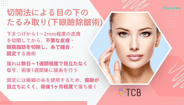 TCBクマ取り切開法による目の下のたるみ取り下眼瞼除皺術