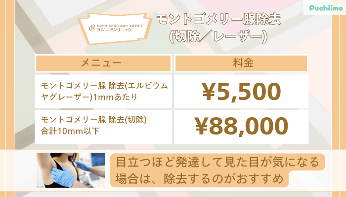 ラジニアクリニックモントゴメリー腺除去切除／レーザー