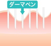品川スキンクリニックダーマペンメカニズム1