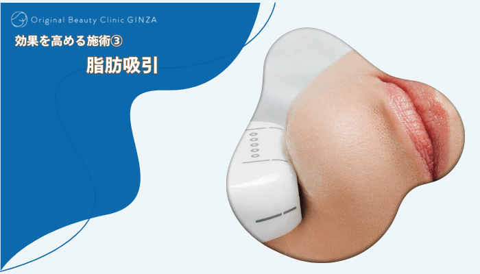 Original-Beauty-Clinic-GINZA糸リフト効果を高める施術3