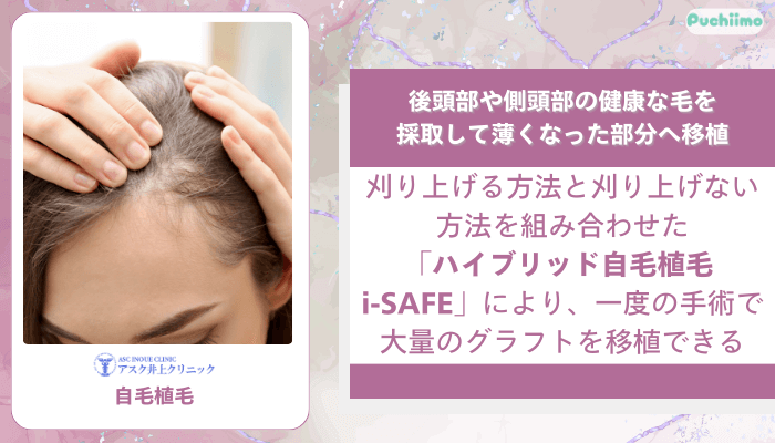 アスク井上クリニック女性薄毛治療自毛植毛