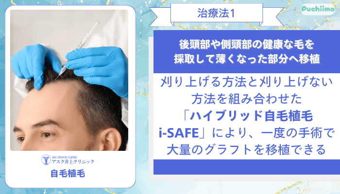 アスク井上クリニック男性薄毛治療自毛植毛