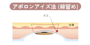 アポロンクリニック二重埋没アポロンアイズ法