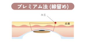 アポロンクリニック二重埋没プレミアム法