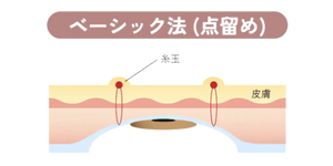 アポロンクリニック二重埋没ベーシック法