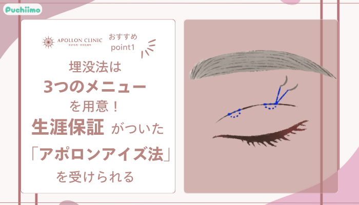 アポロンクリニック二重整形おすすめポイント1