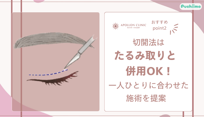 アポロンクリニック二重整形おすすめポイント2