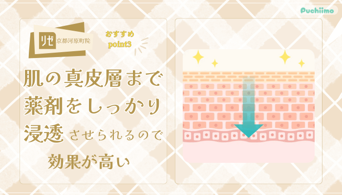 リゼクリニック京都河原町ポテンツァおすすめポイント3