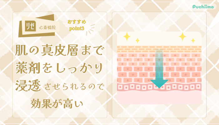 リゼクリニック心斎橋ポテンツァおすすめポイント3