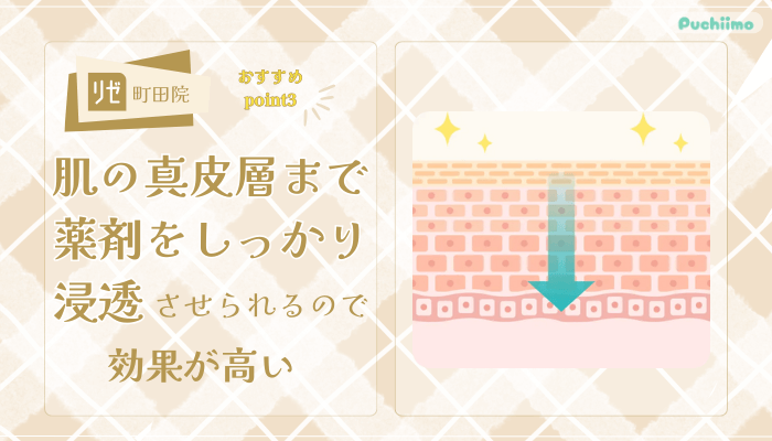 リゼクリニック町田ポテンツァおすすめポイント3