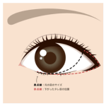 アナザークリニック銀座たれ目デザインD