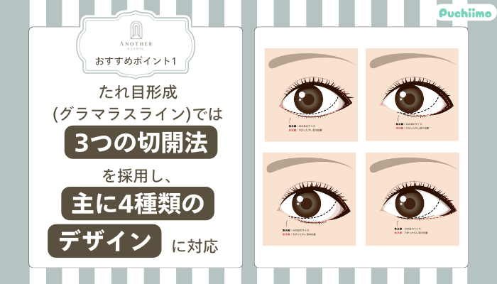 アナザークリニック銀座たれ目形成おすすめポイント1