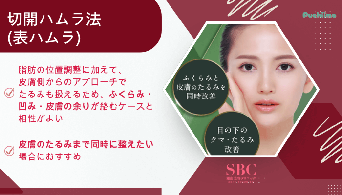 SBCクマ取り切開ハムラ法