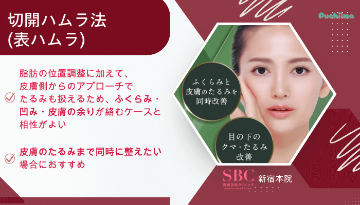 SBC新宿クマ取り切開ハムラ法