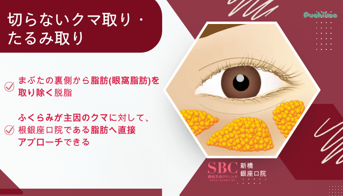 SBC新橋銀座口クマ取り切らないクマ取り・たるみ取り