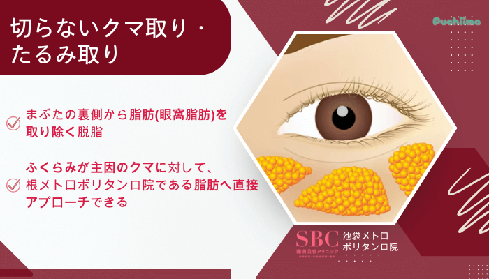 SBC池袋メトロポリタン口クマ取り切らないクマ取り・たるみ取り