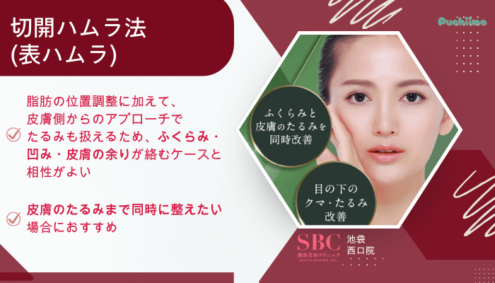 SBC池袋西口クマ取り切開ハムラ法