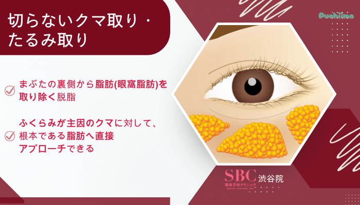 SBC渋谷クマ取り切らないクマ取り・たるみ取り