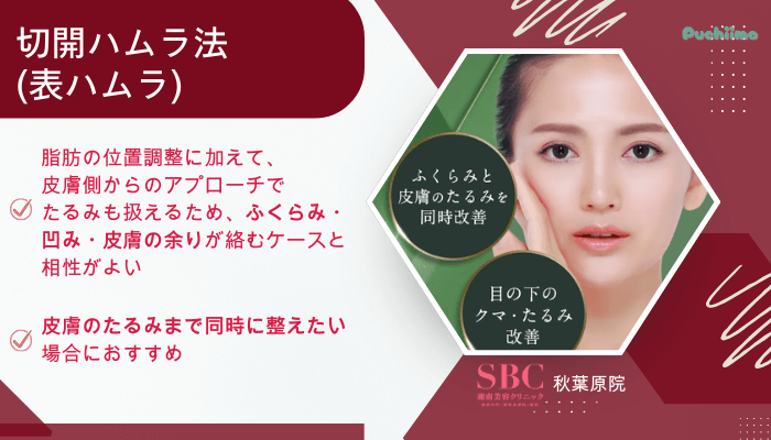 SBC秋葉原クマ取り切開ハムラ法