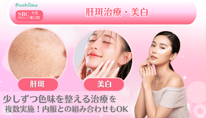 SBC大宮東口美肌治療肝斑治療・美白