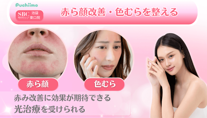SBC池袋東口美肌治療赤ら顔改善・色むらを整える