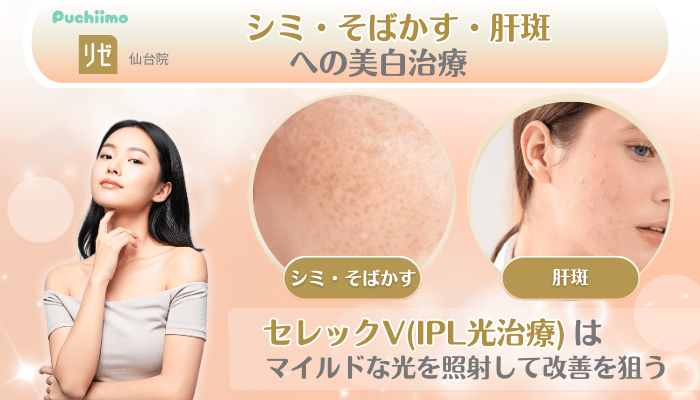 リゼクリニック仙台美肌治療シミ・そばかす・肝斑への美白治療