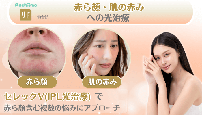 リゼクリニック仙台美肌治療赤ら顔・肌の赤みへの光治療